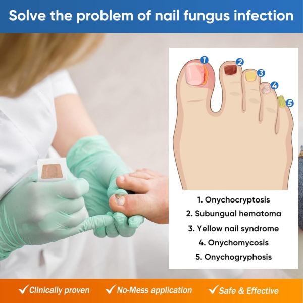 Nāgělpīlz Pflaster, Zehennagel Behandlung, Schnell Und Einfache Effektiv Nagelreparatur Linderung Für Beschädigte Nägel Und Das Erscheinungsbild Verfärbter Nägel - Image 2