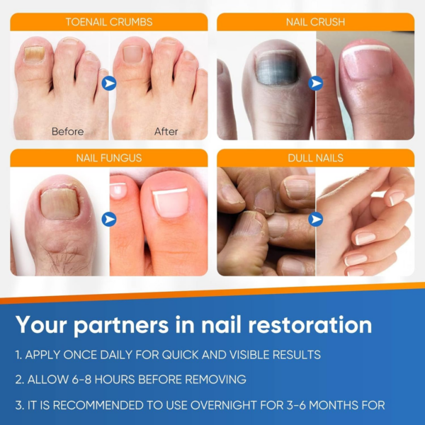 Nāgělpīlz Pflaster, Zehennagel Behandlung, Schnell Und Einfache Effektiv Nagelreparatur Linderung Für Beschädigte Nägel Und Das Erscheinungsbild Verfärbter Nägel - Image 5