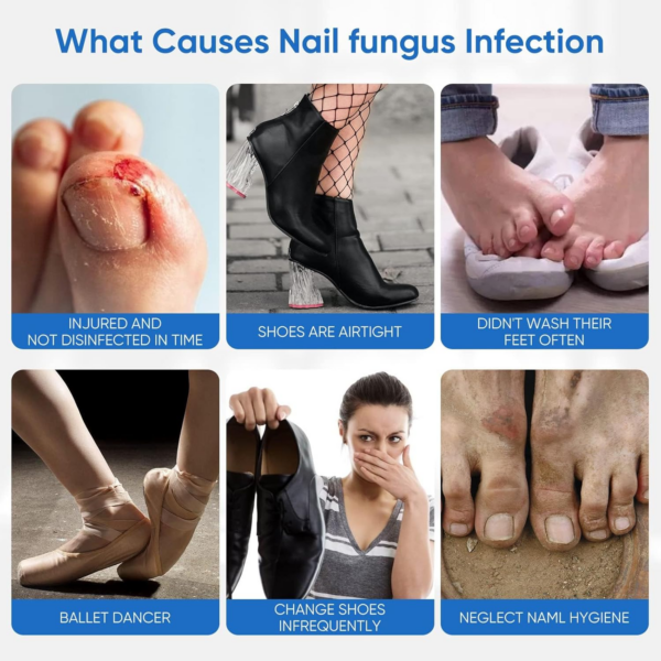 Nāgělpīlz Pflaster, Zehennagel Behandlung, Schnell Und Einfache Effektiv Nagelreparatur Linderung Für Beschädigte Nägel Und Das Erscheinungsbild Verfärbter Nägel - Image 6